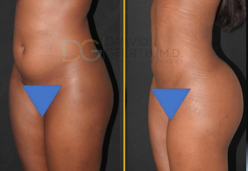 Before and after Lipo360 and BBL treatment showing patient's torso and buttocks from rear angle