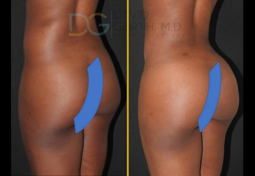 Before and after liposuction and Brazilian butt lift results showing patient's posterior view with blue markings indicating treatment areas