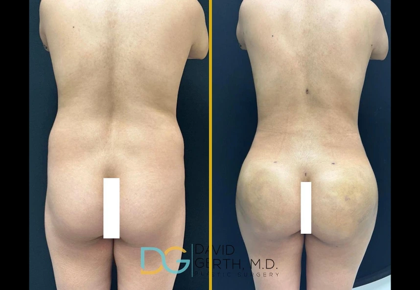 Before and after rear view of Lipo360 and BBL results showing reduced flanks and enhanced gluteal contour