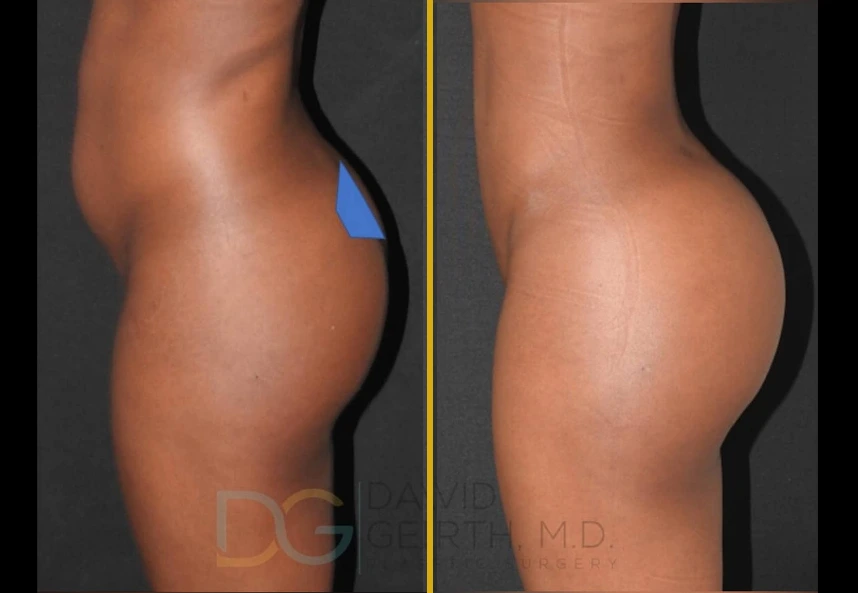 Before and after side profile comparison of liposuction and Brazilian butt lift results