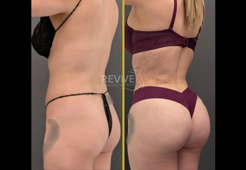 Before and after liposuction 360 with fat transfer to buttocks and hips, showing rear view comparison