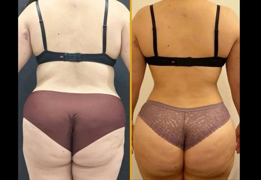 Before and after rear view of natural BBL results showing improved buttock contour and definition