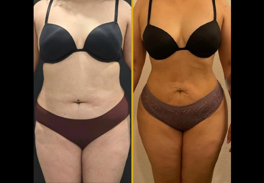 Before and after Brazilian butt lift results showing improved body contour and shape