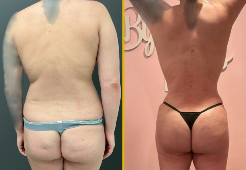 ETT-Back-Lipo-BBL-Back-Jplasma-1.1