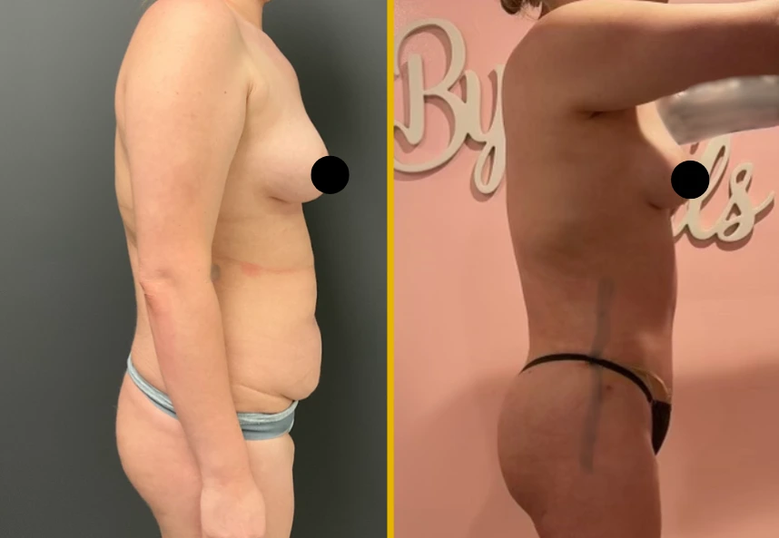 ETT-Back-Lipo-BBL-Back-Jplasma