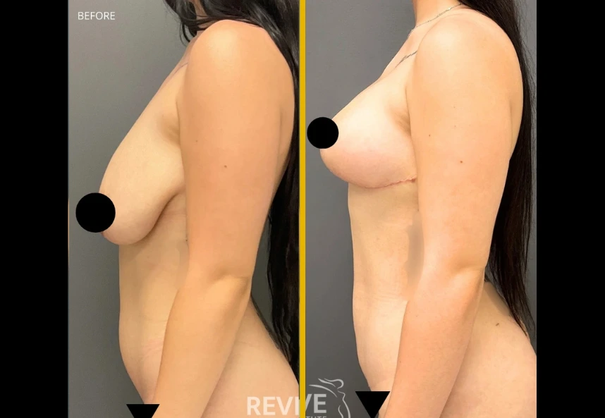 Revive-xlift-and-breast-lift-b