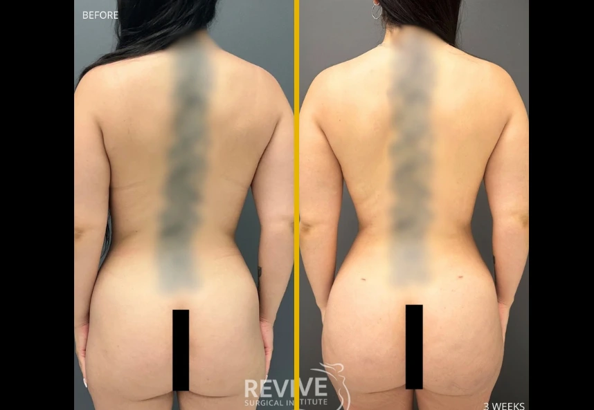 Revive-xlift-and-breast-lift-c