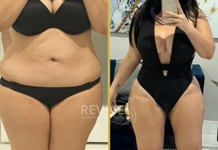 Before and After Gallery: Liposuction