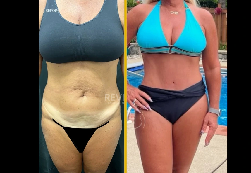 Before and After Gallery: Liposuction