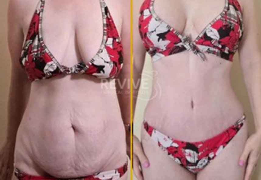 Before and After Gallery: Tummy Tuck