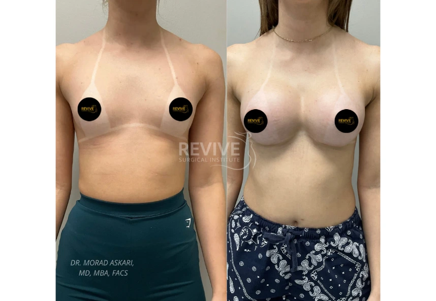 Breast Augmentation (2)
