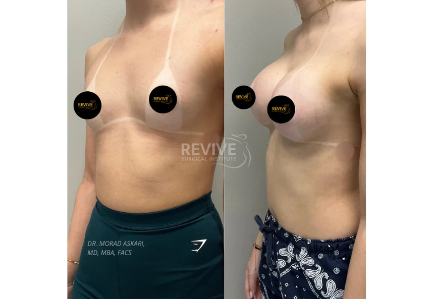 Breast Augmentation (3)