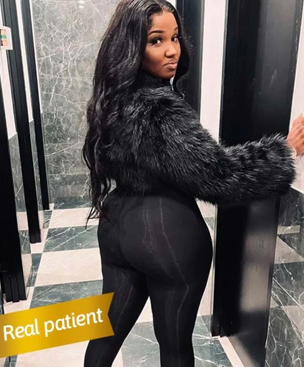 Ideal Candidate for Brazilian Butt Lift Banner