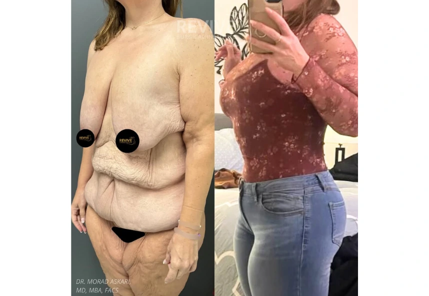 Revive Xlift case 77-2