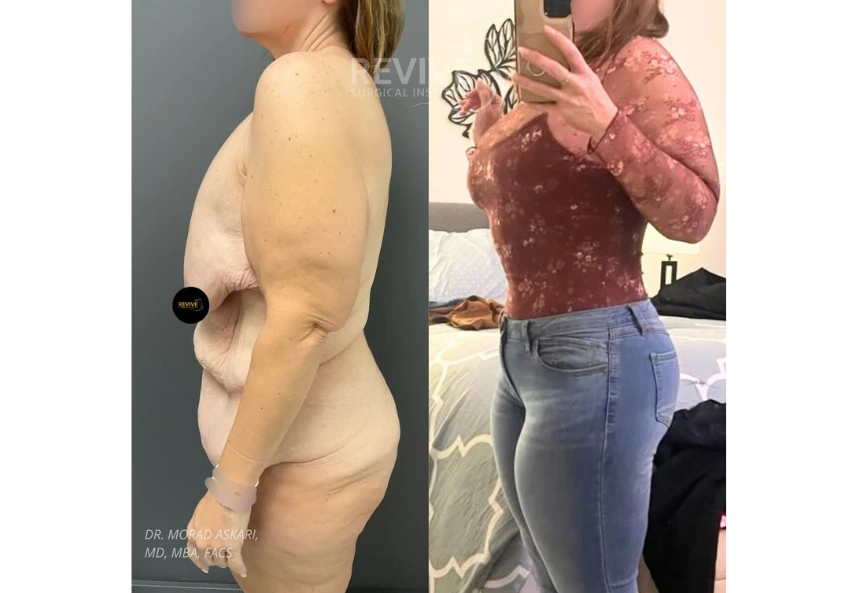 Revive Xlift case 77-3