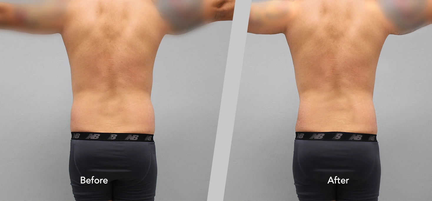 Before and After Gallery: Gynecomastia A Banner