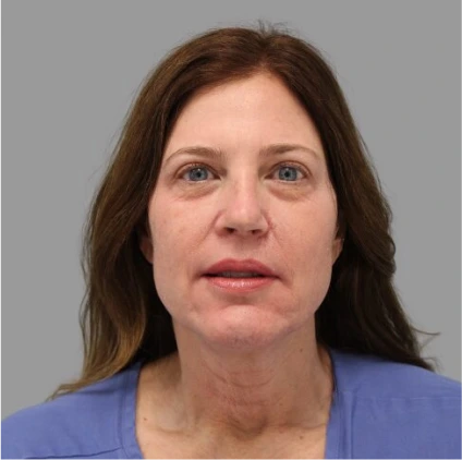 Facelift – Case 4 Before & After Banner