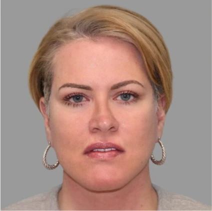 Facelift – Case 5 Before & After Banner