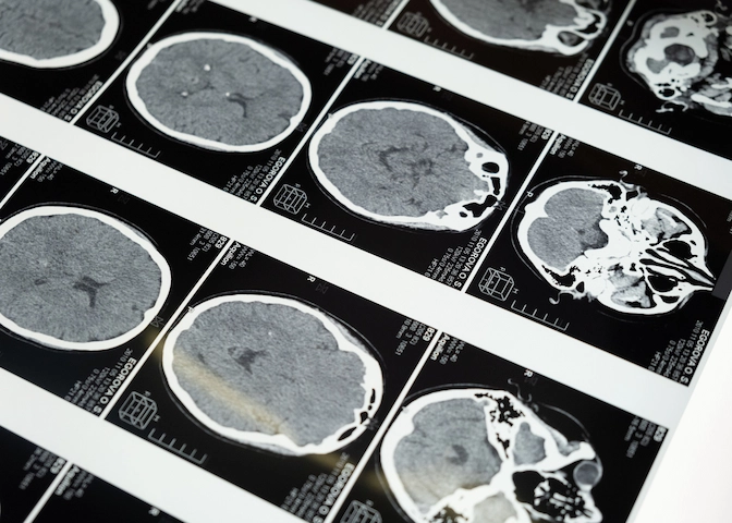Brain MRI scans displayed on a lightbox for medical review