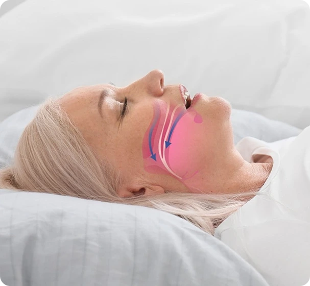 Airlift for Sleep Apnea Treatment