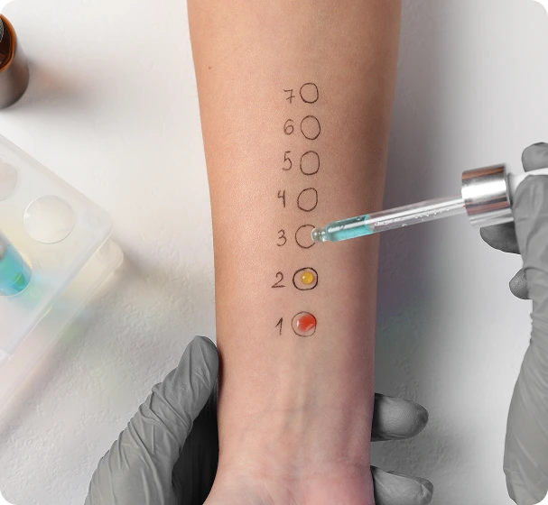 Allergy Testing
