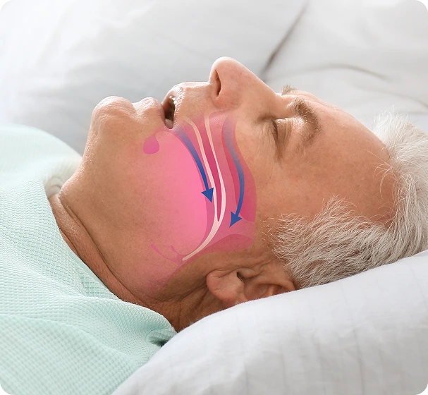 Balloon Sinuplasty for Snoring Treatment
