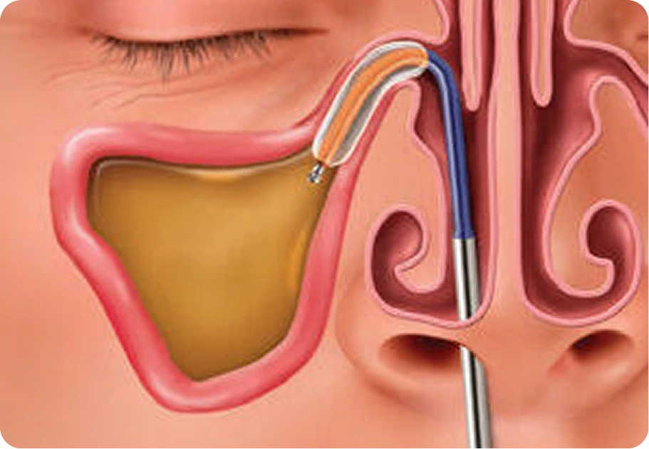Balloon Sinuplasty in Houston, TX Banner