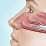 ClariFix® Cryotherapy