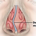 Deviated Septum