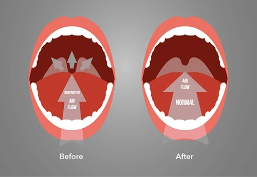 Injection Snoreplasty
