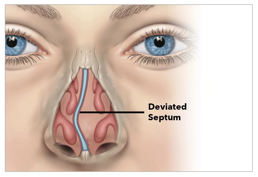 Septoplasty Impact the Shape of My Nose
