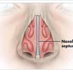 Septoplasty Treatment