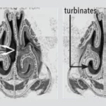 Turbinate Reduction