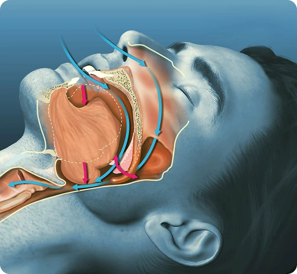 Uvu﻿lopalatopharyngoplasty Treatment