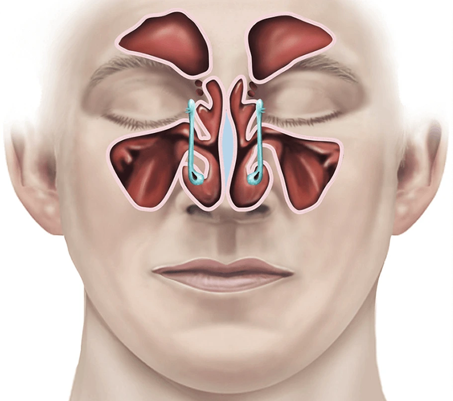 What Is Functional Endoscopic Sinus Surgery (FESS) in Houston, TX Banner