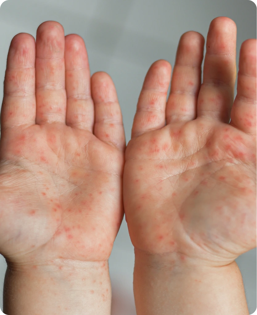 Hands with red rash and inflammation across palms and fingers showing contact dermatitis symptoms