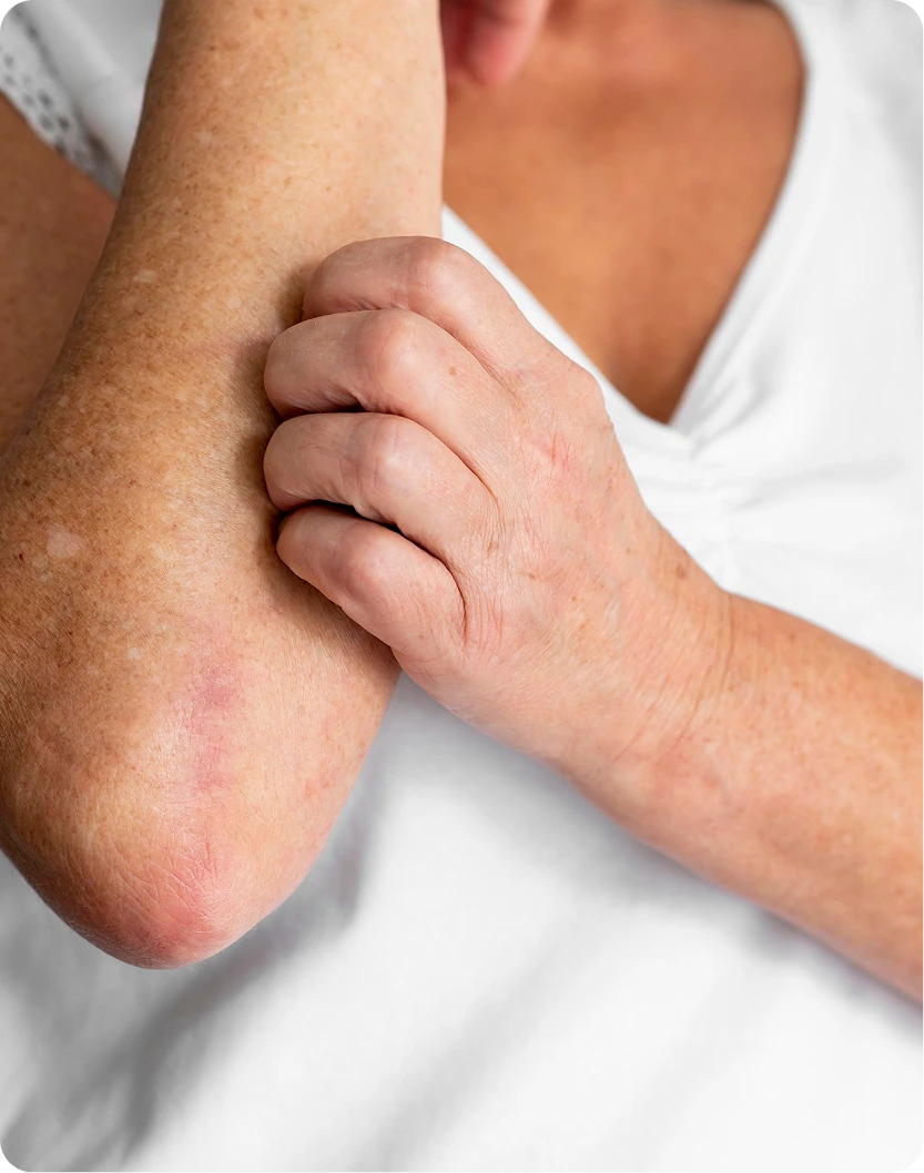 Child's hand resting on adult's arm showing red, inflamed contact dermatitis rash