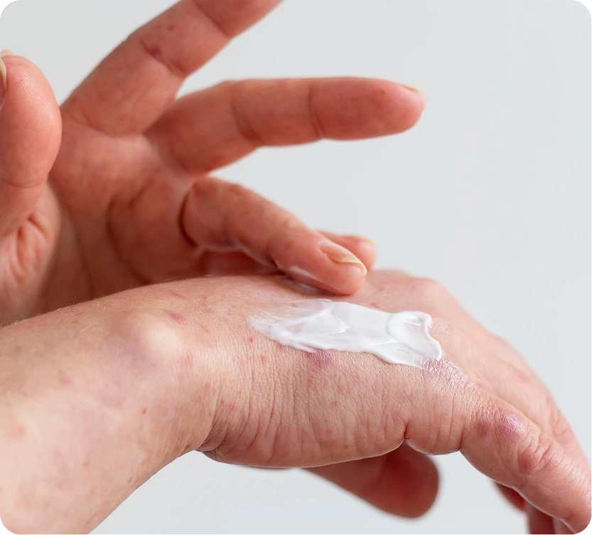 Hand showing contact dermatitis rash with cream applied to affected skin area