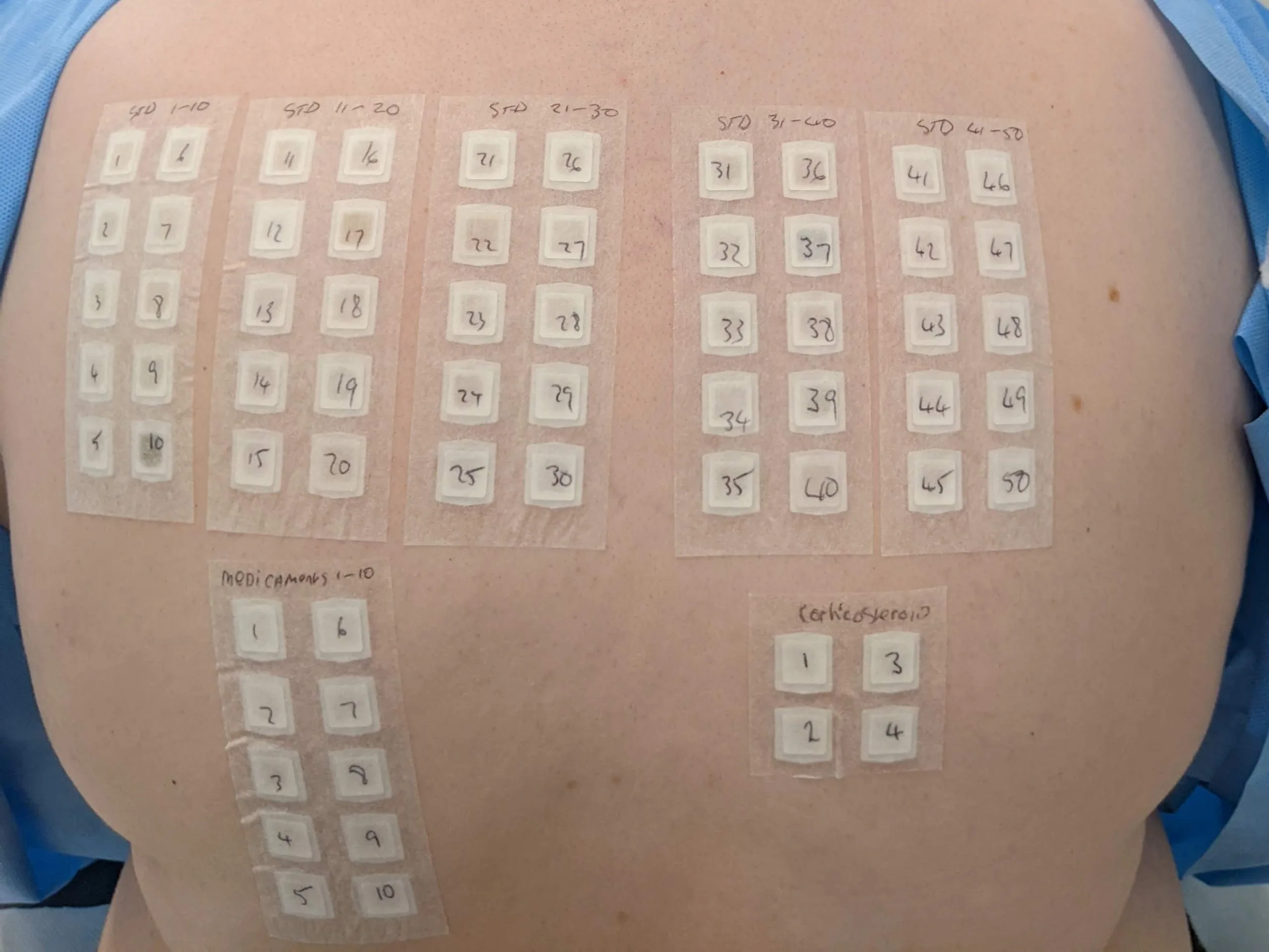 Patch testing on a patient's back for allergic contact dermatitis