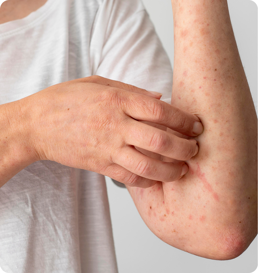Person scratching arm showing contact dermatitis rash on elbow and forearm