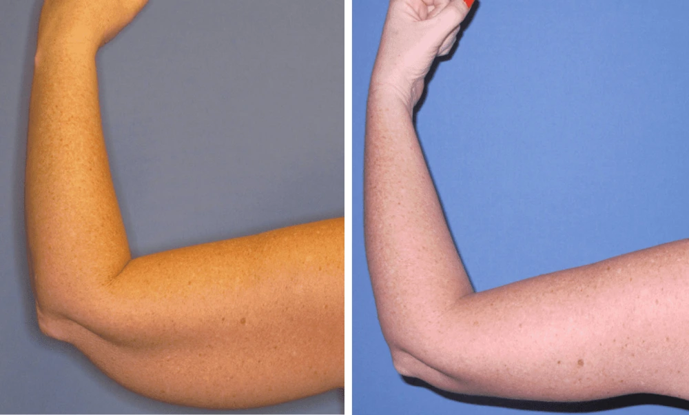 Arm Lift – Case 1 (1)