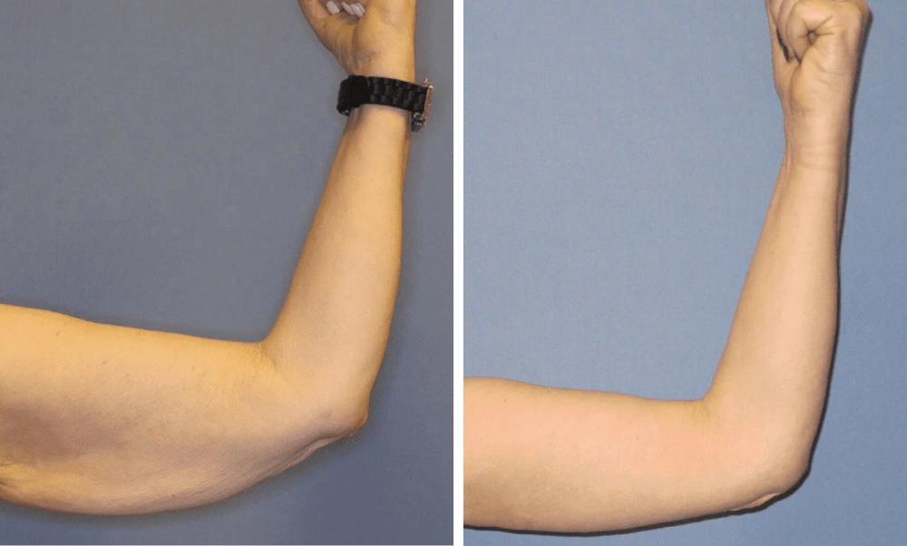 Arm Lift – Case 2 (1)