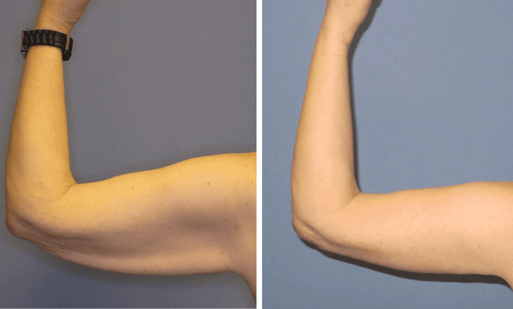 Arm Lift – Case 2 (2)