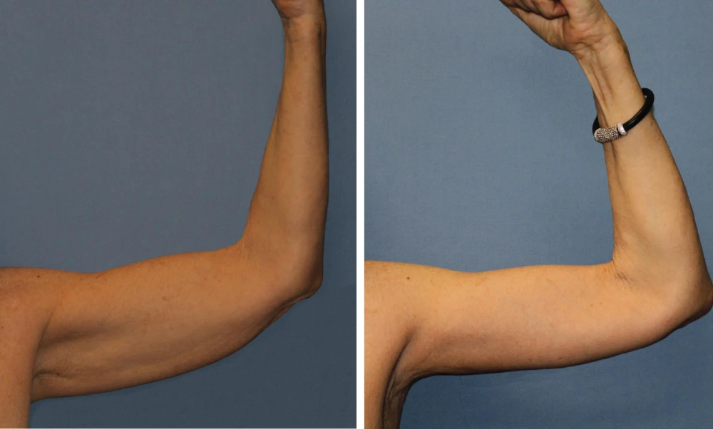 Arm Lift – Case 3 (1)