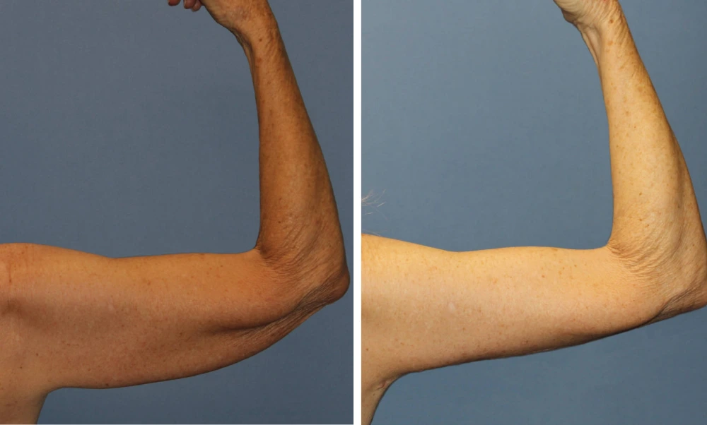 Arm Lift – Case 3 (2)