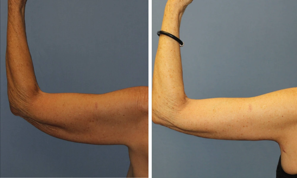 Arm Lift – Case 3 (3)