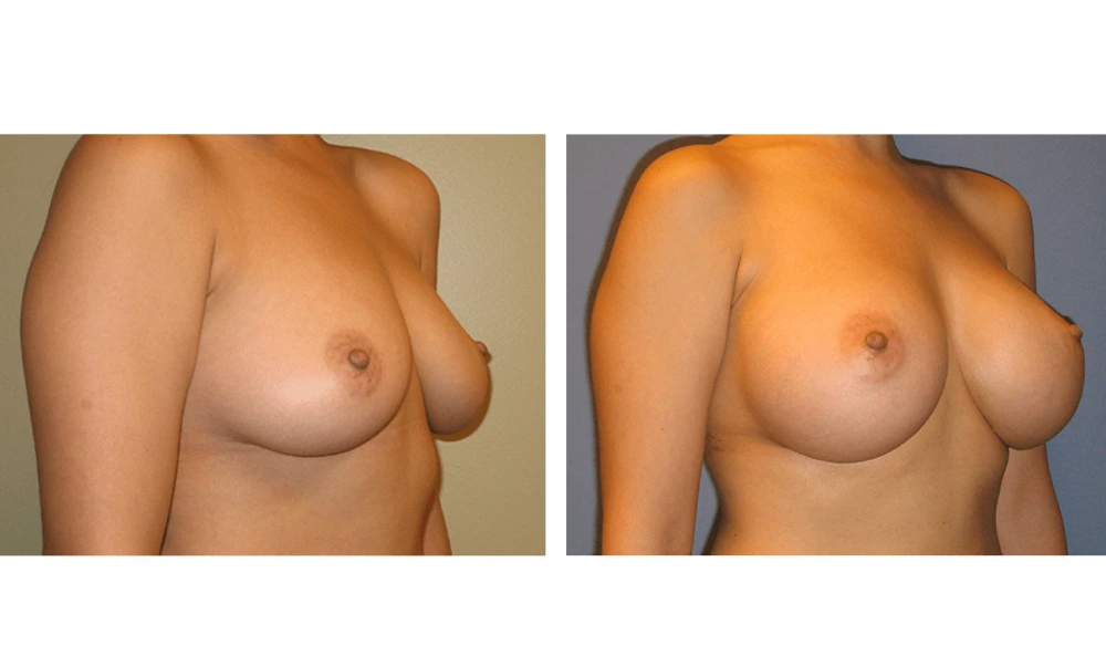 Breast Augmentation - Case 1 (2)