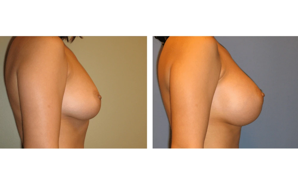 Breast Augmentation - Case 1 (3)