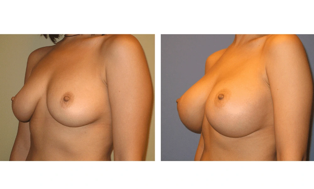 Breast Augmentation - Case 1 (4)