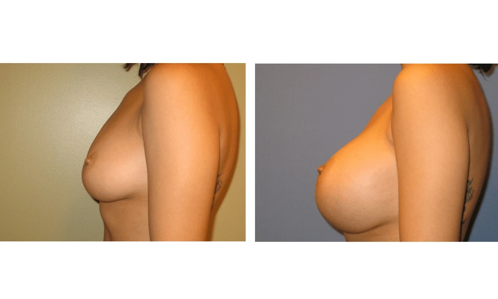 Breast Augmentation - Case 1 (5)